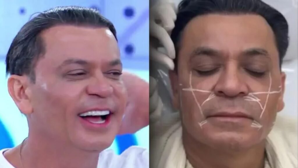 harmonização facial do Frank Aguiar